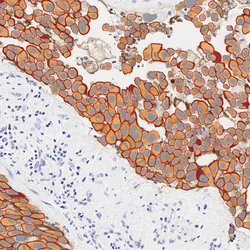 IHC tissue section with AI cell segmentation overlays color-coded by biomarker expression intensity for quantitative companion diagnostic scoring.