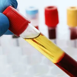 A blue glove holding a vial full of plasma and blood