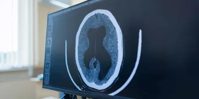 A brain scan with an enlarged ventricle shown on a computer screen