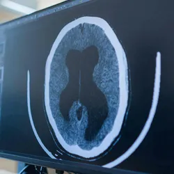 A brain scan with an enlarged ventricle shown on a computer screen