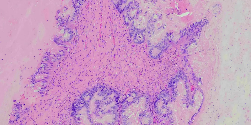 A microscopic view of pancreatic ductal adenocaricoma.