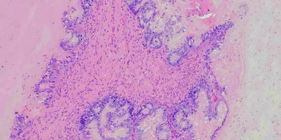 A microscopic view of pancreatic ductal adenocaricoma.